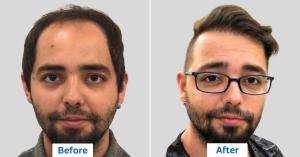 Turkey Cosmetic Surgery Patient - Before and After Comparision image